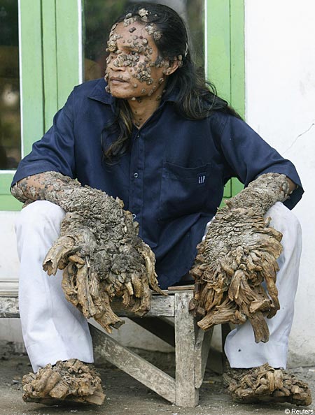 A Man Known as Tree Man Grows Bark like Warts on His Skin | Medical 