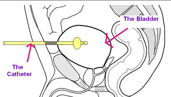 Sub Pubic Catheter