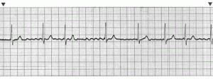Atrial Fibrillaion A-Fib