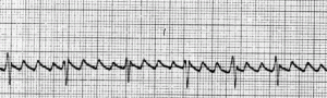 Atrial flutter