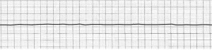 Asystole