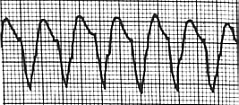Ventricular Tachycardia V-tach