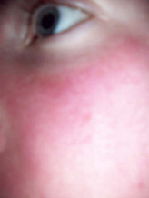 facial flushing, redness on face, rash on face, hives, cholinergic urticaria