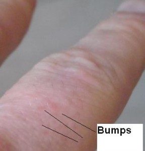 Itchy bumps on fingers, eczema on hands, dishydrotic eczema, rash on fingers, food allergy