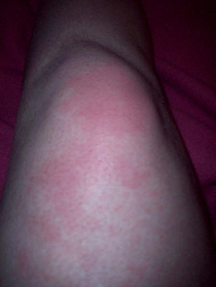 knee flushing, red knee, hives on knee, itchy knee, cholinergic urticaria