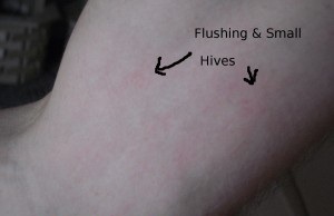 hives on arm, cholinergic urticaria arms, flushing skin