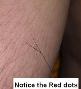 Keratosis Pilaris, Chicken skin, hives, cholinergic urticaria