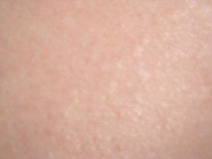 Tinea Versicolor, Discolored Skin, Spots on skin, cholinergic urticaria, hives