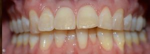 care plan impaired dentition, nursing care plan, crooked teeth,
