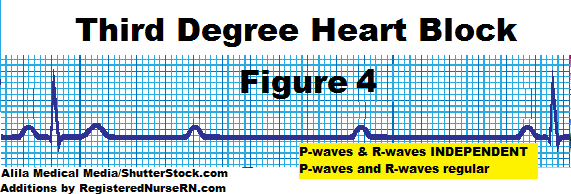 third degree heart block, complete heart block, ekg strip heart block