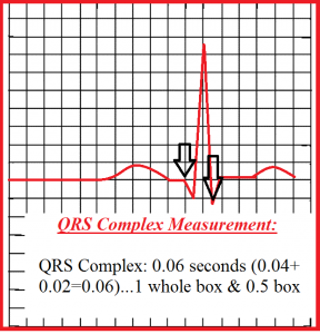 how-to-measure-QRS-complex