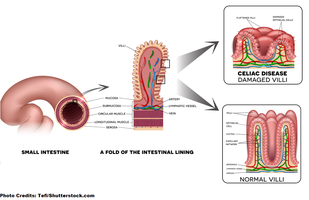 celiac disease, intestinal villi, pathophysiology