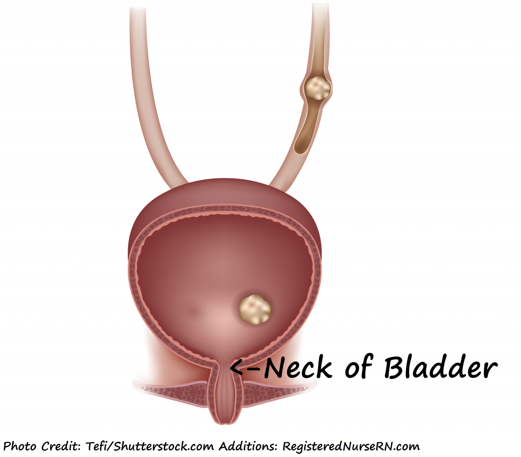 renal stone, bladder neck, kidney calculi, nclex