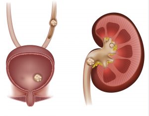 renal calculi, renal stones, kidney stones, nclex