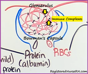 acute glomerulonephritis, poststreptococcal, nclex