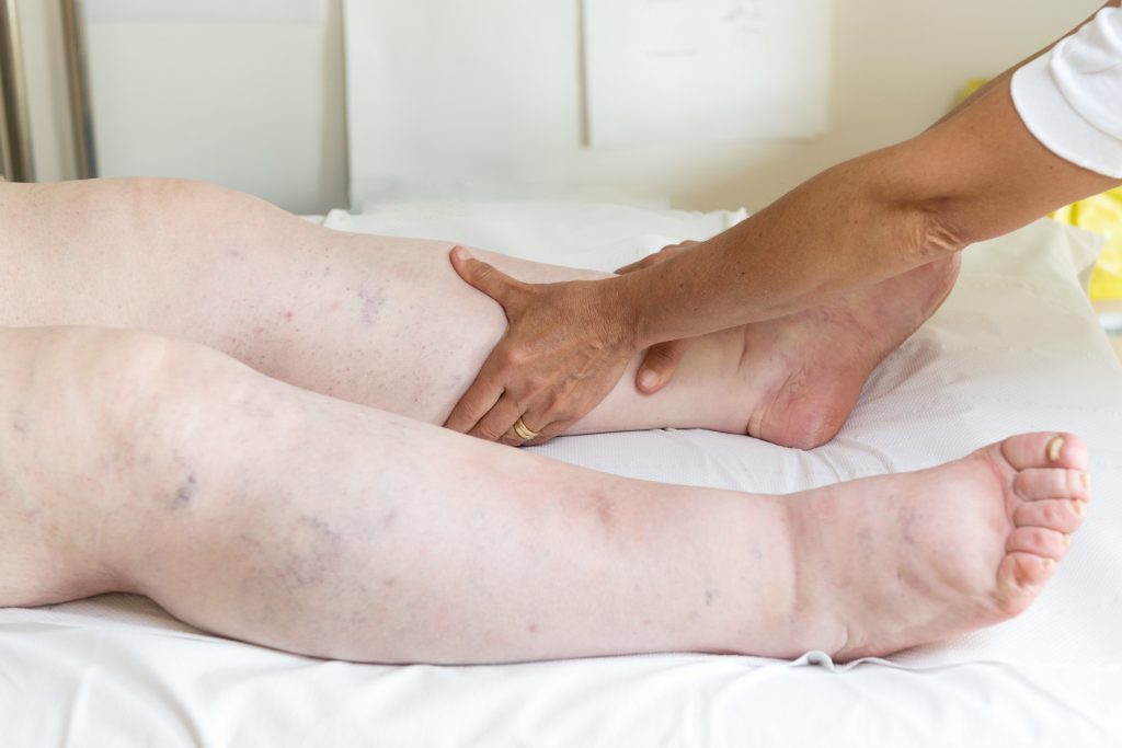 edema, nephrotic syndrome, nclex