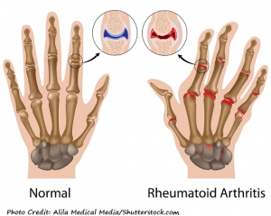 rheumatoid arthritis, ra, nclex, review, nursing