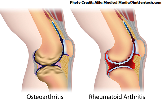 osteoarthritis vs rheumatoid arthritis, oa, ra, nursing, nclex