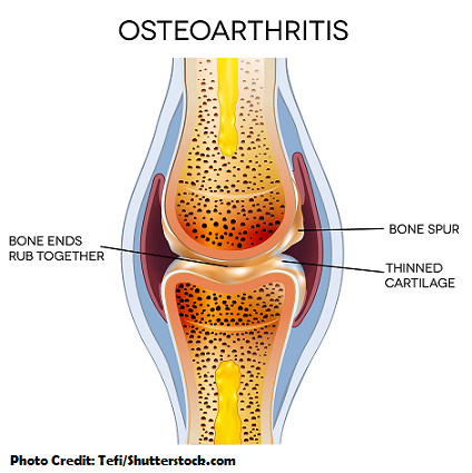 osteoarthritis, nclex, nursing, interventions