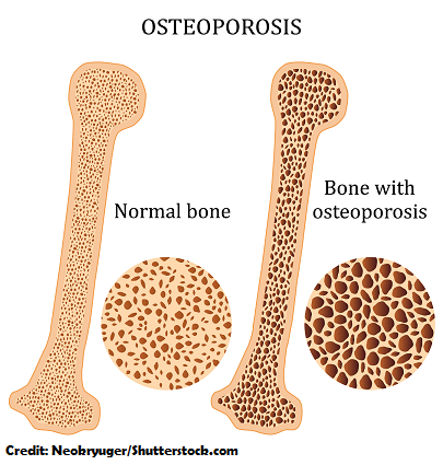 osteoporosis, nclex, nursing, treatment