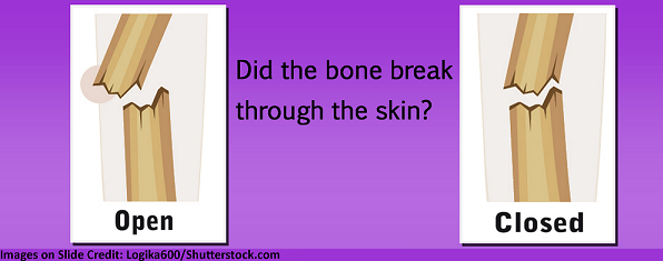 bone fractures, nursing, nclex, types, simple, compound, open, closed