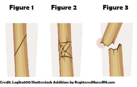 bone fractures, nclex, questions, review, types