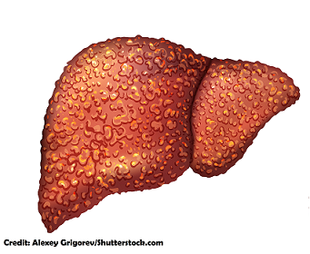 cirrhosis, nursing, nclex, review