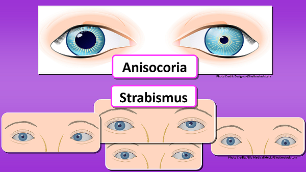 anisocoria, strabismus, nursing, assessment
