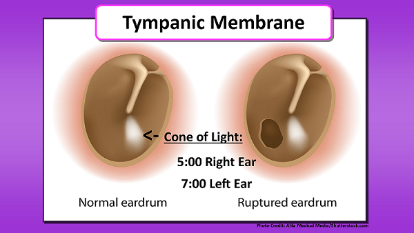 tympanic membrane, cone of light, nursing, assessment, head to toe