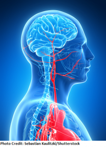 blood supply to brain, stroke, nclex, nursing