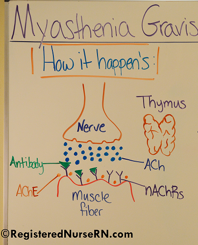 myasthenia gravis, nclex, nursing, acetycholine,
