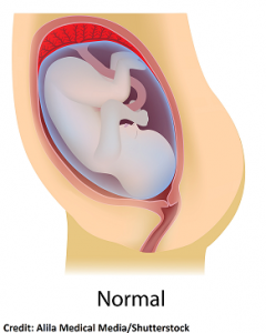placenta previa, nursing, nclex, interventions
