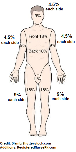 Rule Of 9 S For Burns Chart