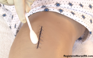 how to remove surgical staples, cleaning, staple removal