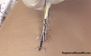 how to remove staples, after surgery, surgical staples