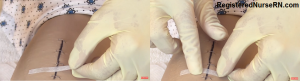steri strips, surgical staples, removal, nursing