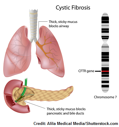 cystic fibrosis, cf, nursing, nclex, interventions, quiz