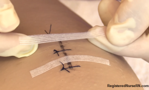 suture removal, steri strips, applying steri strips