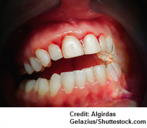 phenytoin, gum gingival hyperplasia, nursing
