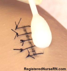 how to remove sutures, removing sutures nursing