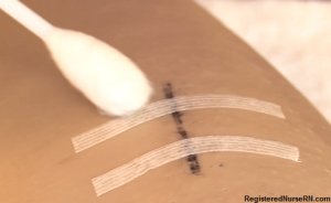 how to remove sutures as a nurse, nursing, nursing skills