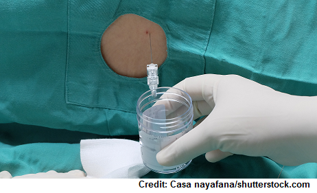 lumbar puncture, guillain barre syndrome, nclex