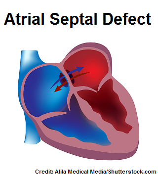 atrial septal defect, asd, nursing, nclex, questions, quiz