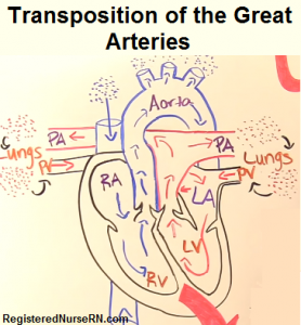 Transposition of the Great Arteries (Vessels) NCLEX Review