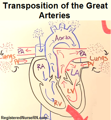 transposition of the great vessels, arteries, TGA, TGV, nursing interventions, nclex, congenital heart defects