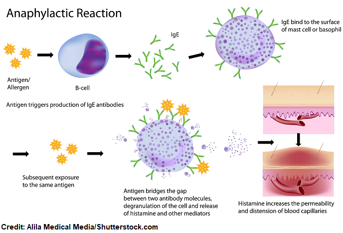 Anaphylactic Shock Pathophysiology Anaphylactic Shock
