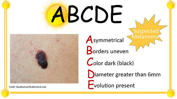 melanoma, skin cancer, abcde assessment, nursing, nclex