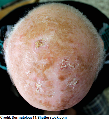 actinic keratosis, skin cancer types, nursing nclex
