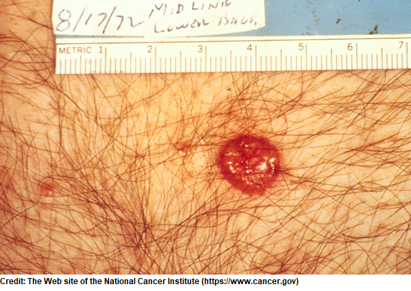 basal cell carcinoma, skin cancer types, nursing nclex