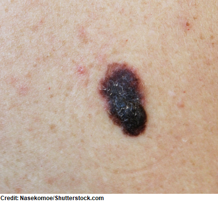 melanoma, skin cancer types, nursing nclex